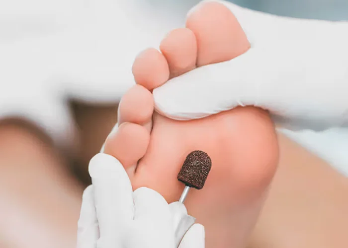 A gloved podiatrist reducing hard skin on the sole of a foot with a sanding burr
